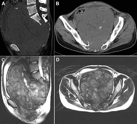 Extremely Large Giant Cell Tumor Of Sacrum With Successful Resection Via Posterior Approach