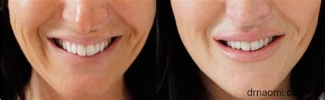 Reduce Smile Lines Around Mouth With Dermal Filler Best Cosmetic