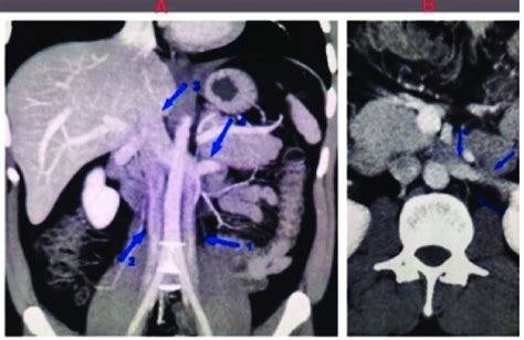 Duplicated Inferior Vena Cava Below The Level Of The Left Renal Vein