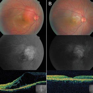 Case 3 A A Red Orange Choroidal Hemangioma Contiguous With Optic