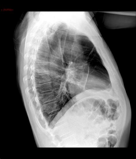 Air Fluid Levels Within An Emphysematous Giant Bullae Eurorad