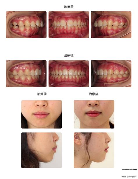 上顎前突症例 ＜正中離開を伴う前歯の前突を改善した非抜歯矯正治療＞ 東京の歯列矯正専門医院 アールエフ矯正歯科