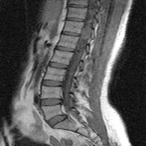 IRM médullaire en séquence T2 et en coupe sagittale du cas n4 montrant