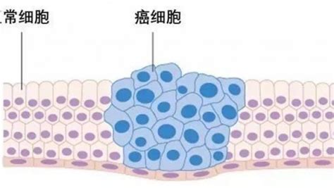 抗癌5年临床治愈经验分享 咚咚肿瘤科 第12页