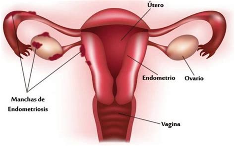 ENDOMETRIOSIS IREGA Biología de la Reproducción