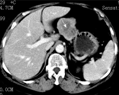 Figure From Laparoscopic Wedge Resection Of Synchronous Gastric