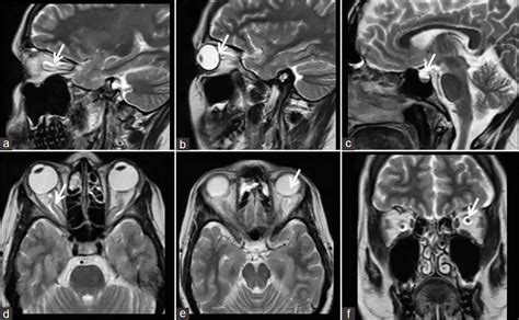 Head Pseudotumor Cerebri | Health Care and Lifestyle