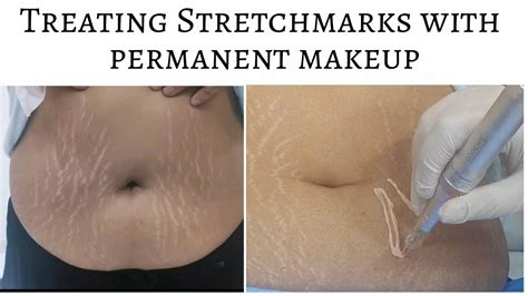 Treating Stretch Marks With Permanent Makeup Stretchmarks