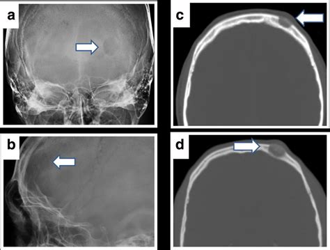 Radiological images of a left frontal intraosseous lesion. a Simple ...