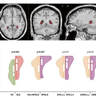 Choroid Plexus Segmentation And Between Group Comparison Choroid Plexus