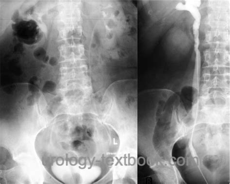 Ureterocele: Symptoms, Diagnosis and Treatment