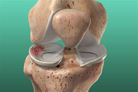 Los Meniscos Son Estructuras Intraarticulares Que Se Ubican En La