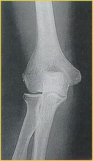 X Ray Elbow AP Diagram Quizlet