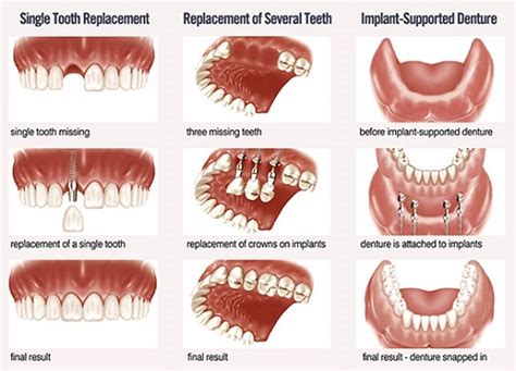 Types-of-Dental-Implants[1] – Gorbatov Dentistry – Your Dentist in ...