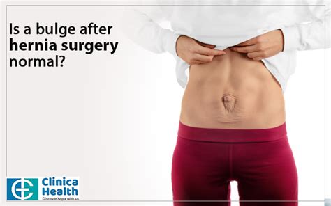 Herniated Belly Button Surgery