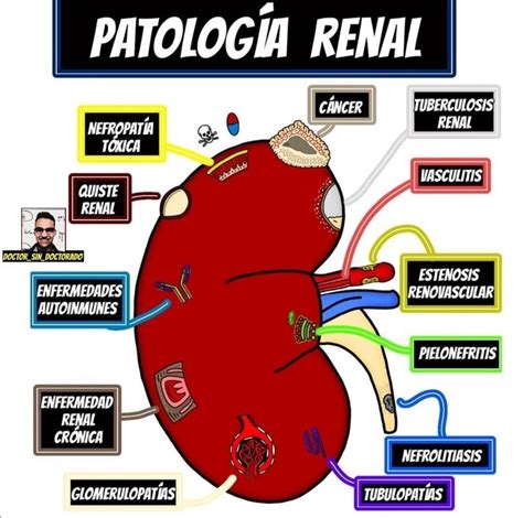 Patolog A Renal Patologia Renal Cosas De Enfermeria Diagnosticos De