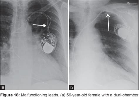 Figure 18 From Radiography Of Cardiac Conduction Devices A Pictorial