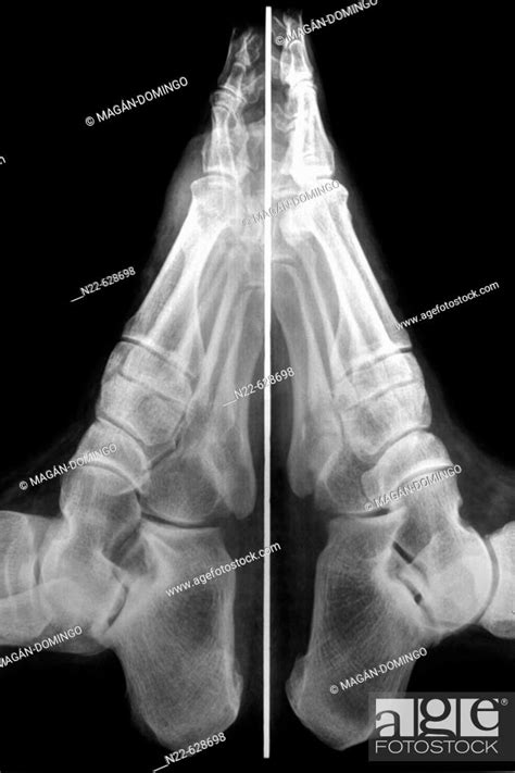 Foot bones X-ray, Stock Photo, Picture And Rights Managed Image. Pic. N22-628698 | agefotostock