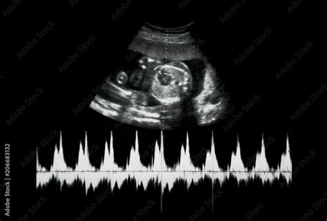 Ultrasound of baby in mother's womb. Stock Photo | Adobe Stock