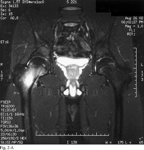 Figure 1 from Tension-sided femoral neck stress fracture in a ...