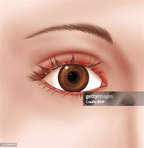 Blepharitis Photos And Premium High Res Pictures Getty Images