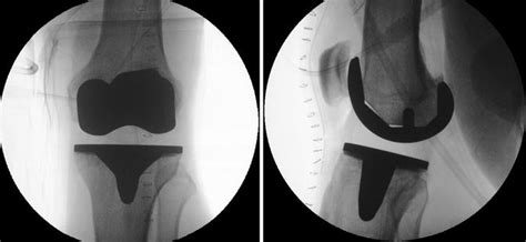 Causes And Diagnosis Of Aseptic Loosening After Total Knee Replacement Musculoskeletal Key