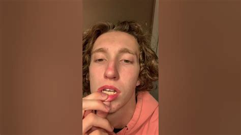 World Record Canker Sore Youtube