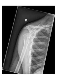 Scapular Y View Diagram Quizlet