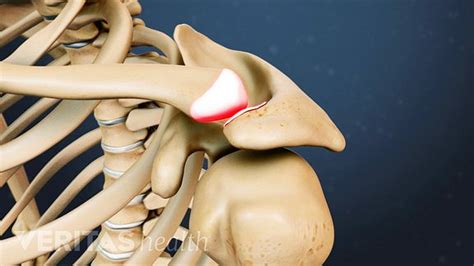 A Visual Guide to Shoulder (AC Joint) Arthritis