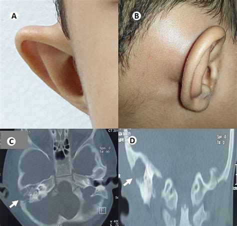 Mastoid Process Ear