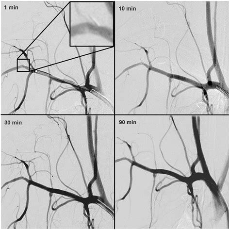 Follow Up Digital Subtraction Angiography Digital Subtraction