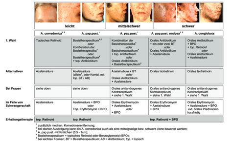 Akne Therapie Habt Ihrs Drauf DocCheck