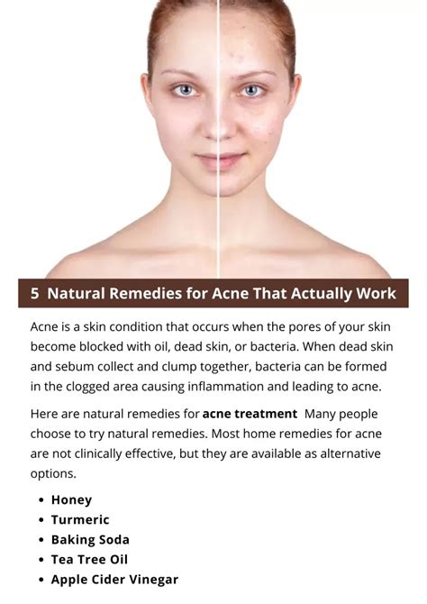 Ppt 5 Natural Remedies For Acne That Actually Work Powerpoint