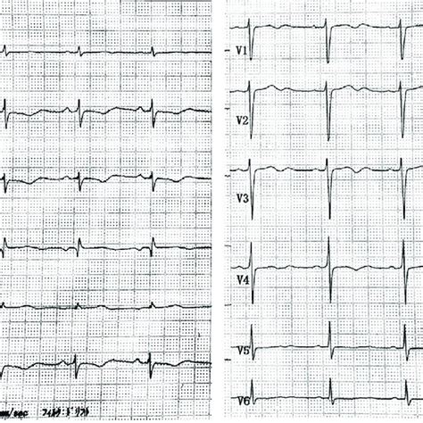 Figure His Electrocardiogram On Admission Showed Sinus Rhythm With A