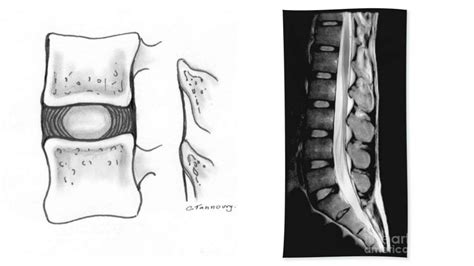 Lumbar Spondylosis X Ray