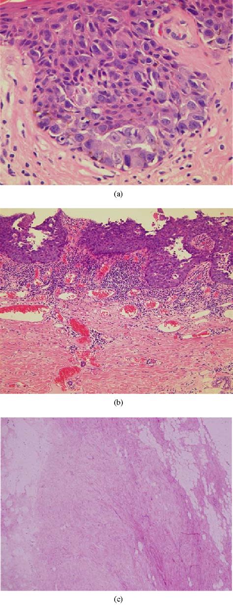 Figure 2 From Extramammary Paget’s Disease Covered The Left Nipple And Areola Semantic Scholar