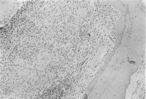 Figure 1 From Viii Fibrosing Mastoiditis Semantic Scholar