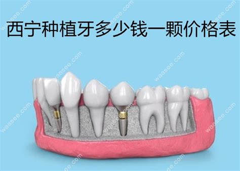 西宁种植牙价格表低价2380起高价13800起均价8090元起 口腔资讯 牙齿矫正网