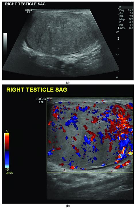 A B Mode Ultrasound Showing Enlargement And Infiltration Of The