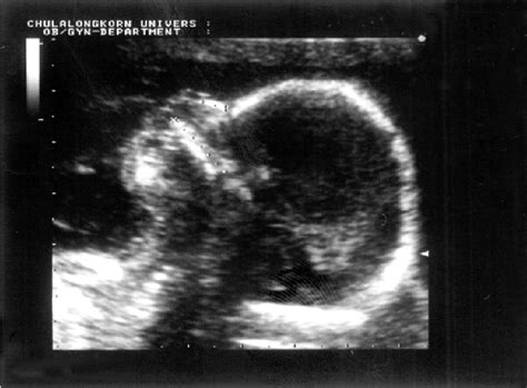 Figure From Nasal Bone Hypoplasia In Trisomy At To Weeks