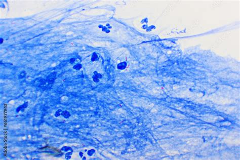 Mycobacterium Tuberculosis Positive Small Red Rod In Sputum Smear Acid Fast Stain Analyze By