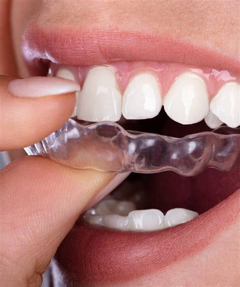 Gouttière dentaire transparente en Algérie Naoufel Dental Center