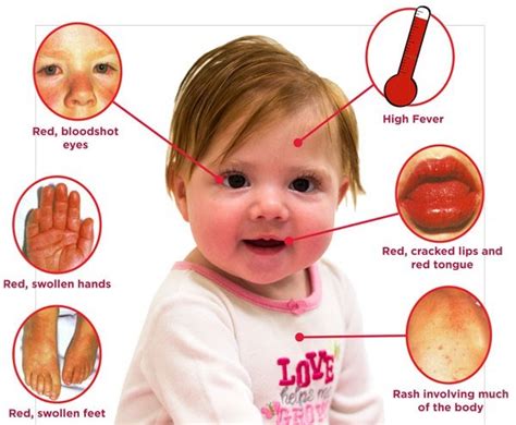 가와사키병 Kawasaki Disease Mucocutaneous Lymph Node Syndrome 양쪽결막충혈