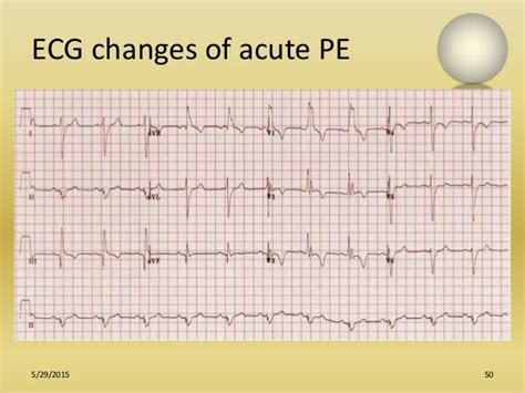 Role Of Ecg In Pulmonology