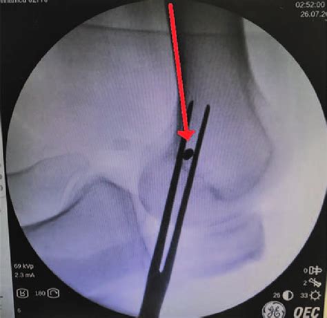 Radiographic Landmarks For Isometric Femoral Tunnel Placement