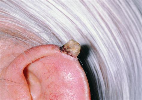 Cutaneous Horn On Ear Photograph By Dr P Marazzi Science Photo Library