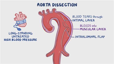 Aortic dissection: Video & Meaning | Osmosis