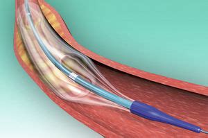 Coronary Stent Biomatrix Alpha Biosensors International Cobalt