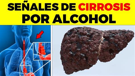 Asi Empieza La Cirrosis Por Alcohol Y Nadie Te Lo Dice Signos Y