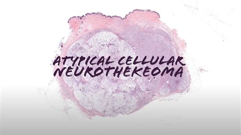 Atypical Cellular Neurothekeoma Australasian Dermpath 2022 Case 4 Pathology Dermatology